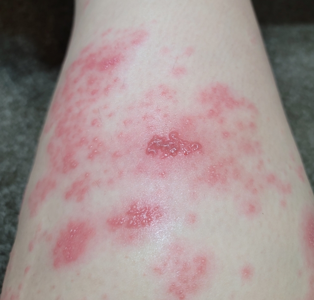 【皮膚科監修】帯状疱疹はうつるの？ワクチンは必要？どの診療科にかかる？気になる疑問をまとめて解説！
